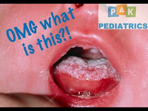Tongue infection?! Newborn Oral thrush and treatment | Let’s Talk About!