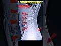 L S Spine X Ray Shorts Xray Radiographerusn Radiography