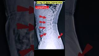 Download lagu L-S Spine X-ray #shorts #xray #radiographerusn #radiography mp3