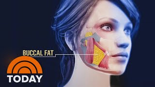 Buccal fat removal: Inside latest trend to reshape the face