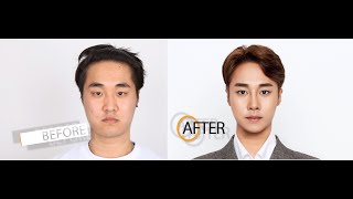 Male Plastic Surgery Transformations | Seoul Guide Medical