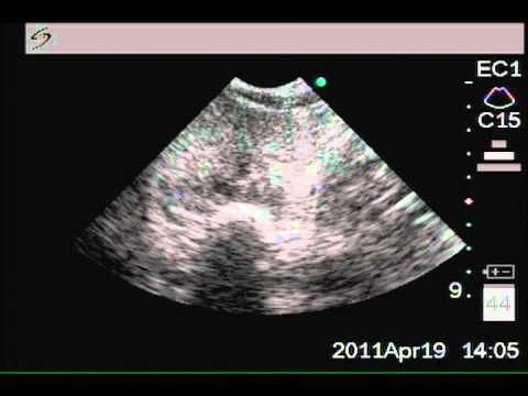 Medicina uomini BPH Flora è scarsa nella prostata