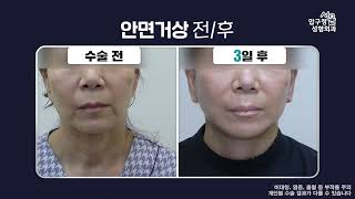 *안면거상 1달차 경과 ❗ 주목 ❗