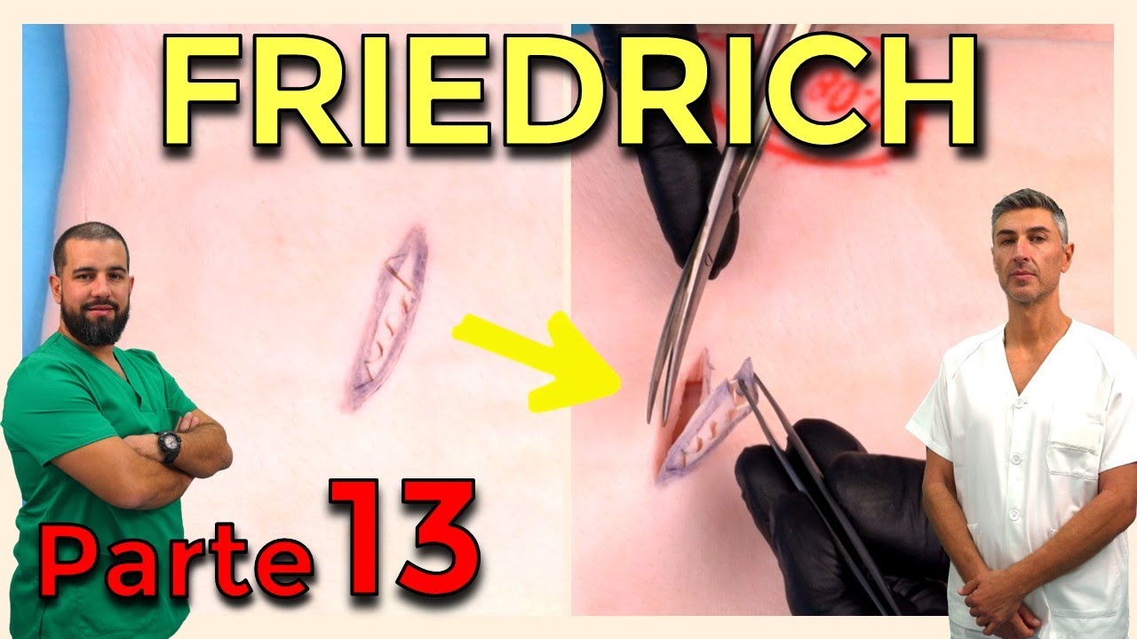FRIEDRICH en HERIDAS – CIRUGÍA MENOR y SUTURAS (Parte 13)