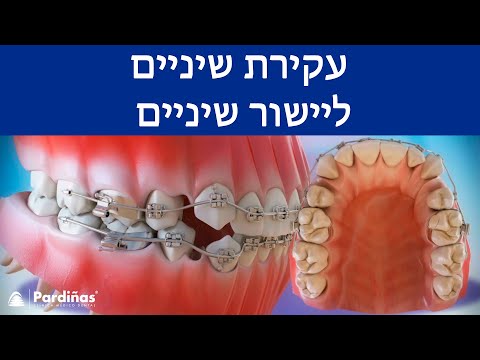 © עקירת שיניים ליישור שיניים