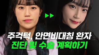 실제 환자 케이스 분석🔍주걱턱, 비대칭 환자 양악 수술 계획🖥️ 이렇게 바꿨습니다✨ 썸네일 이미지