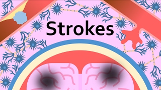 Strokes and the Brain
