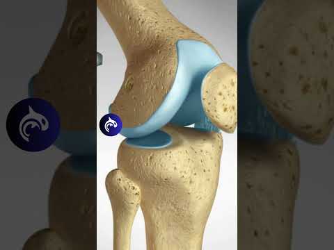 ACL Anterior Cruciate Ligament MCL Medial Collateral Ligament Tear and Repair No Narration
