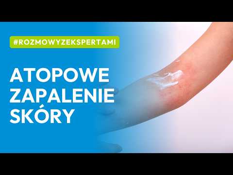Atopowe Zapalenie Skóry Bez Tajemnic