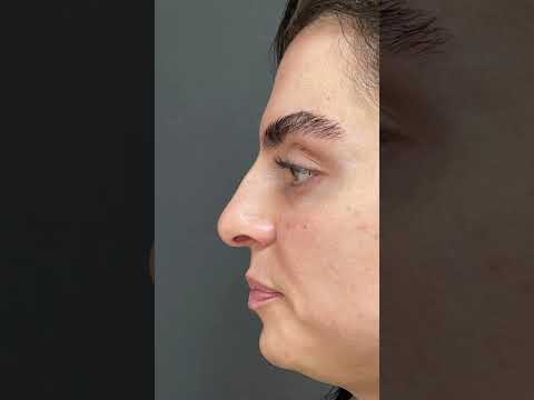 Rhinoplasty 3 months after surgery in Turkey | Dr. Umut Erdoğan