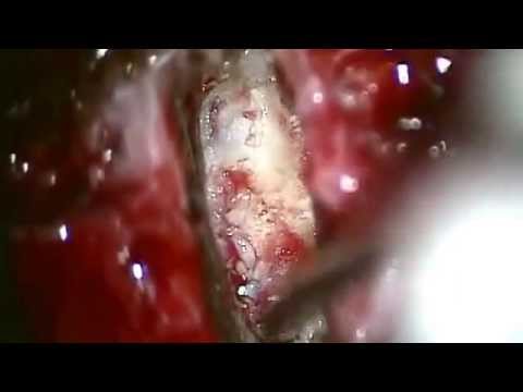Trattamento di Spinal Cerotto al peperoncino La terapia esercizio medico Butrimova per scheda video del collo dellutero