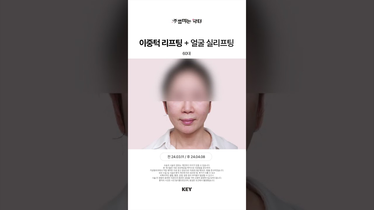 60대 이중턱리프팅 대구키성형외과