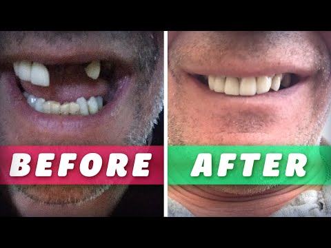 MISSING TOOTH TEMPORARY Teeth Replacement Repair False Diy Temp