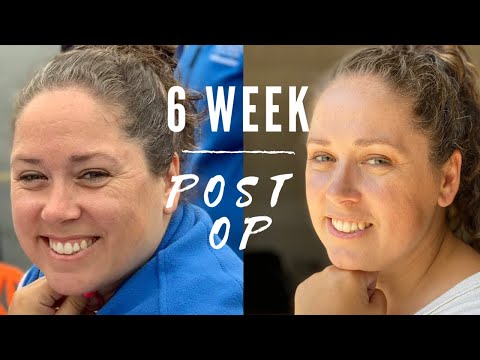 6 Weeks Post Op//Vertical Sleeve Gastrectomy//Why You Should Give The Scale A Rest