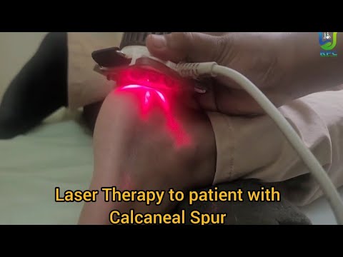 Laser Therapy for Calcaneal Spur 