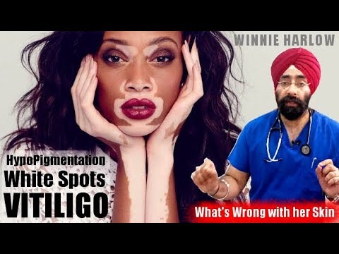 WHITE SPOTS | VITILIGO | HYPOPIGMENTATION | LEUCODERMA : Winnie Harlow Skin (in ENG) by Dr.Education Video