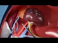 Kidney Transplant Surgery: Stages and Patient Information
