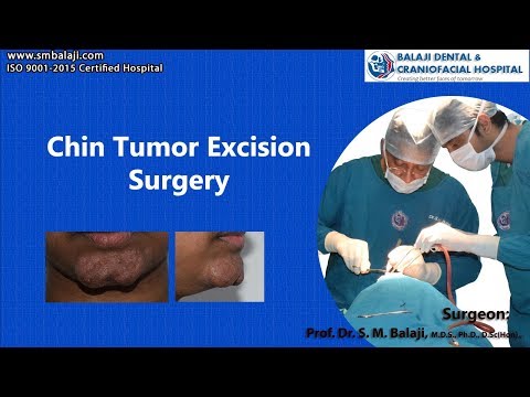 Chin Tumor Excision Surgery