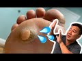 Wart Pops into Doctor's Face!