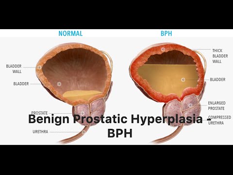 Prostate Problems: Why They Happen & How to Fix Them