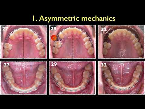 CC444. Correction of Collapsed Class lll Malocclusion and Dentofacial asymmetry