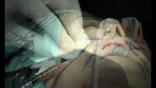 הזרקת שומן להסרת קמטים