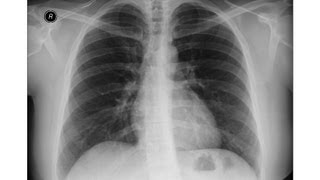 Chest x-ray, Interstitial Lung Disease, Lung Fibrosis, traction bronchiectasis,Sarcoidosis