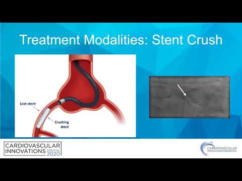 Stent loss algorithm-Robert Riley, MD