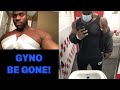 Post Gynecomastia Surgery Update