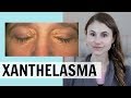 XANTHELASMA: WHAT IT IS & HOW IT IS TREATED| DR DRAY