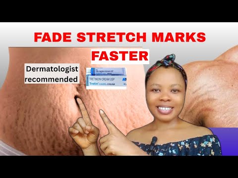 How To Fade Stretch marks| Best Stretch marks Cream/Remove Stretch marks