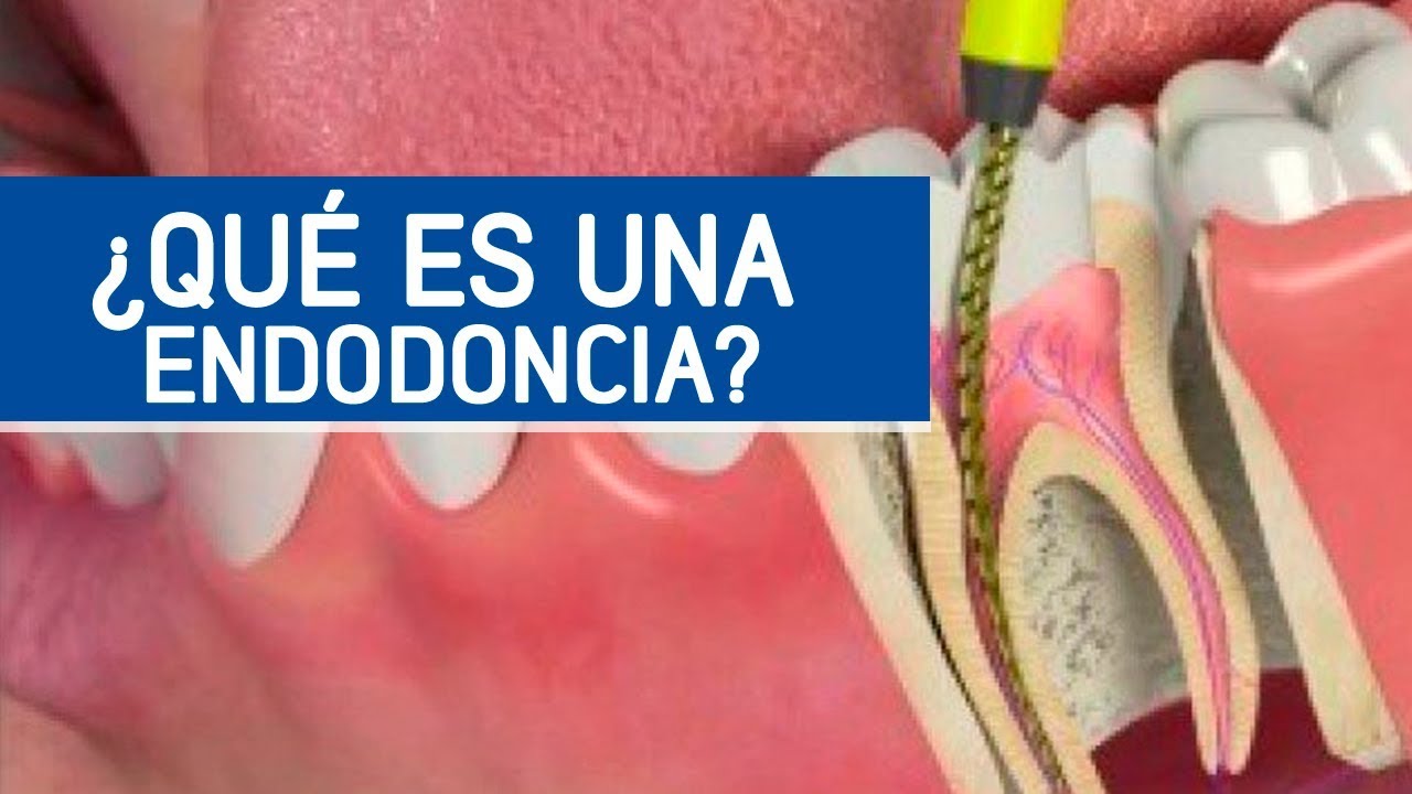 Watch Cómo es una endodoncia, matar el nervio dental / Odontoespecialistas Now Cómo es una endodoncia, matar el nervio dental / Odontoespecialistas