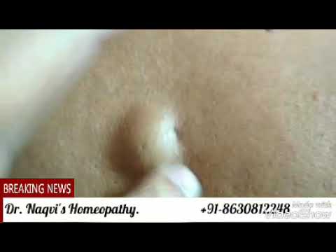 Rs. 2000 homeopathic treatment for lipoma.for 1 month, male