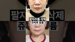 팔자주름 간단하게 없애는 방법