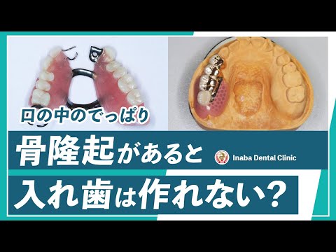 口の中のでっぱり 骨隆起があると入れ歯は作れない？