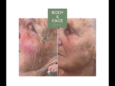 Non-surgical neck lift and face