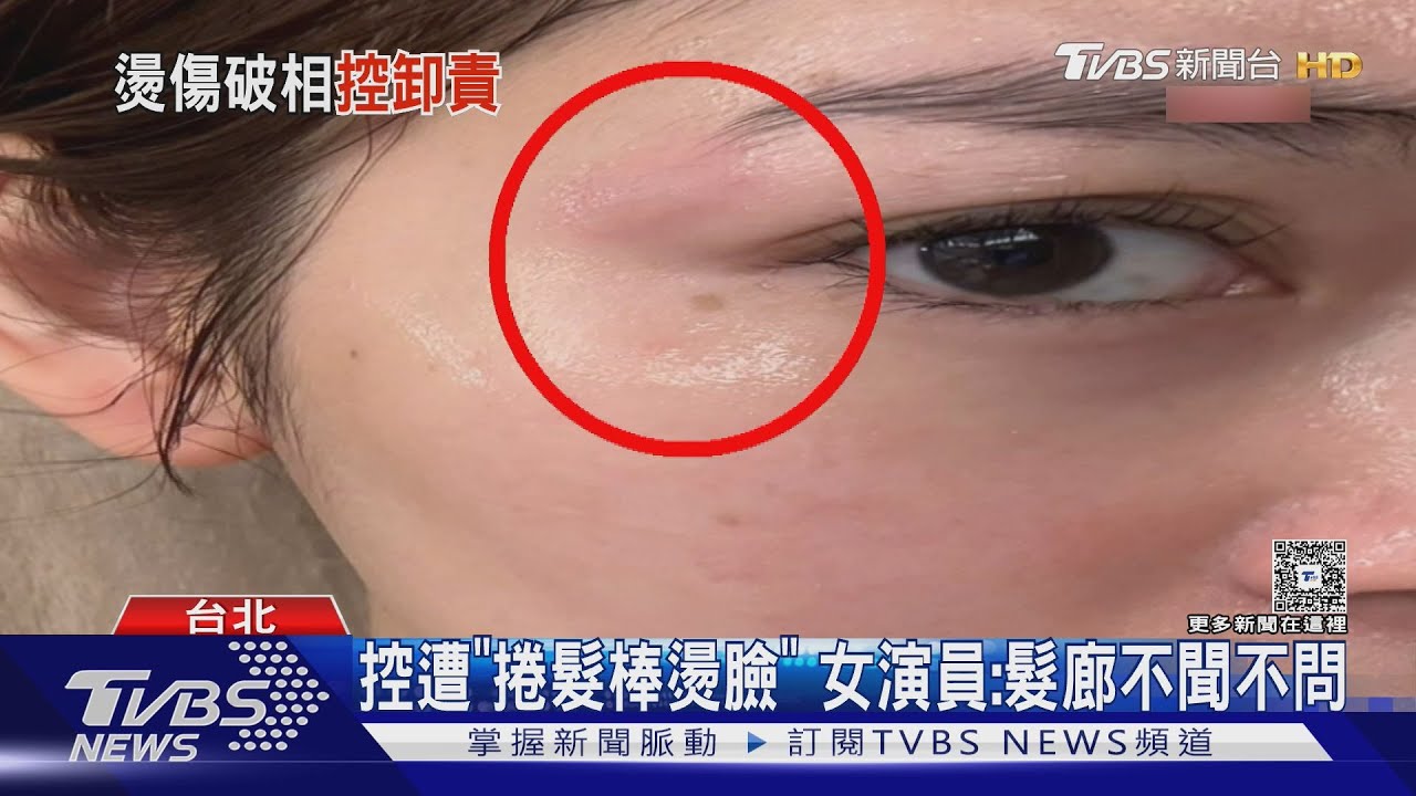 控遭「捲髮棒燙臉」 女演員:髮廊不聞不問