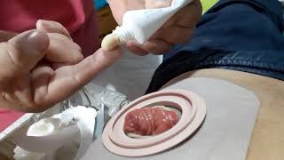 Colostomía cambio de bolsa parte 2