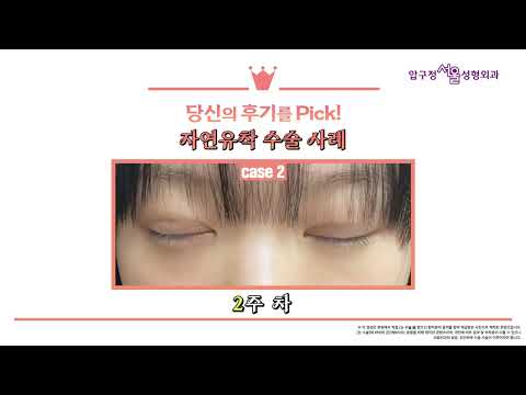 쌍꺼풀 전후 2CASE | 자연유착 수술 결과