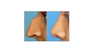 preview picture of video 'Rhinoplasty Risks - What are the Risks in Rhinoplasty'
