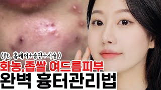 (Subs) 여드름피부 흉터없애는법⁉️ 무조건 이렇게 하세요‼️ 심한 화농성 여드름, 흉터관리비법 ㅣ시술,홈케어,습관 l 인보라INBORA