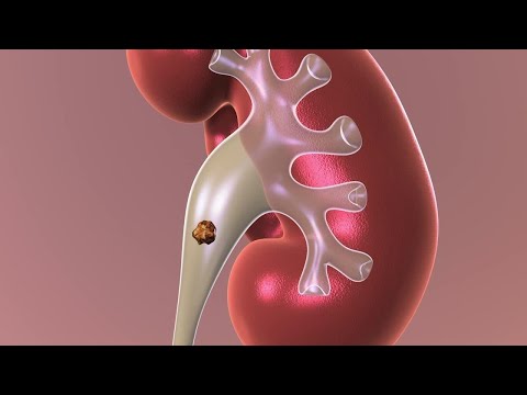 Observation: Non-surgical Approach to Kidney Stones