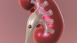 Observation: Non-surgical Approach to Kidney Stones