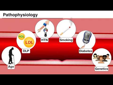 Ischemia 1/7 - Introduction and pathophysiology of ACS