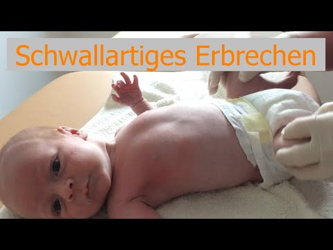 Pylorusstenose bei Babys: schwallartiges Erbrechen.