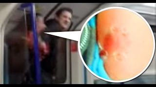 WOMAN BITES MAN 'S ARM IN LONDON DISGUSTING