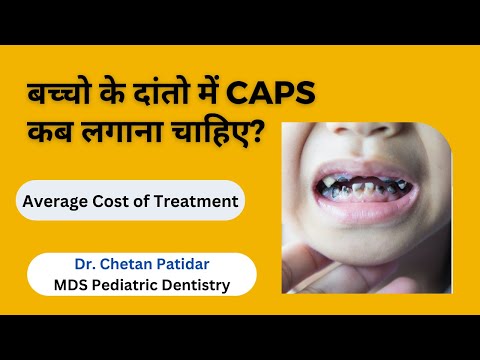 Caps in kids Milk teeth | बच्चों के दांतों पर कैप कैसे लगाते हैं | Average Cost of Treatment
