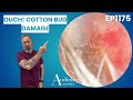 Red Raw Ear Canal Huge Ear Wax Plug Removal EP1175