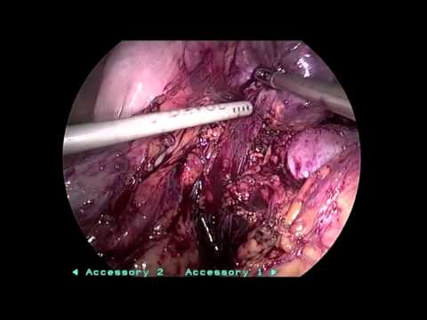 Laparoscopic Bilateral Partial Andrenalectomy for Bilateral Pheochromocytoma