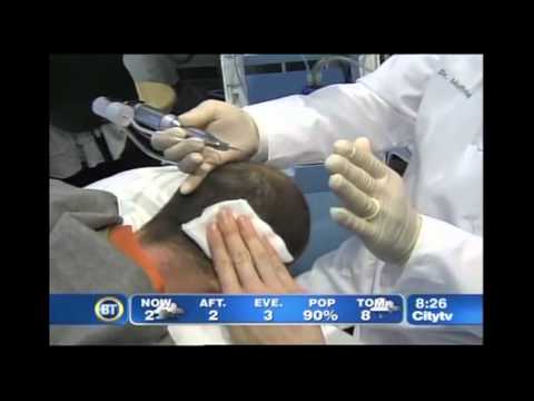 NeoGraft Hair Transplant Demonstartion on BT Canada | Plastic Surgery Talk